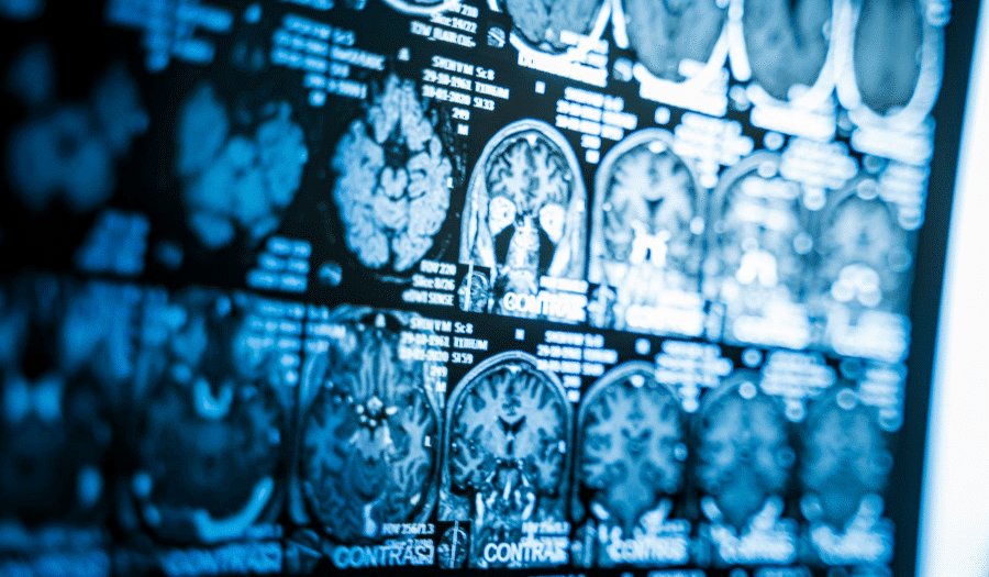 TBI brain scan traumatic brain injury TBI brain scan traumatic brain injury